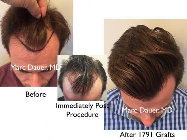 Click image for larger version

Name:	Hair Transplant Slides copy12.004.jpg

Size:	18.9 KB
ID:	45558