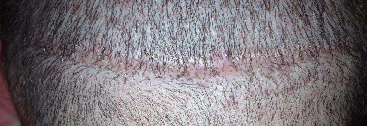 Click image for larger version

Name:	21 day lower scar.jpg

Size:	113.0 KB
ID:	15806