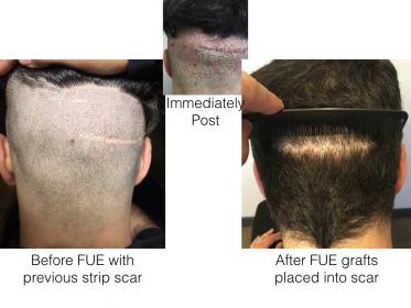 Click image for larger version

Name:	FUE into scar.001.jpg

Size:	17.2 KB
ID:	52670