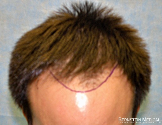 Click image for larger version

Name:	1100_3b_position-hairline.jpg

Size:	96.8 KB
ID:	45098