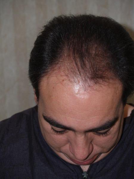 Before FUE procedure