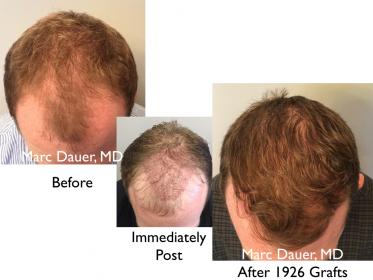 Click image for larger version

Name:	Hair Transplant Slides copy01.004.jpg

Size:	16.0 KB
ID:	48144