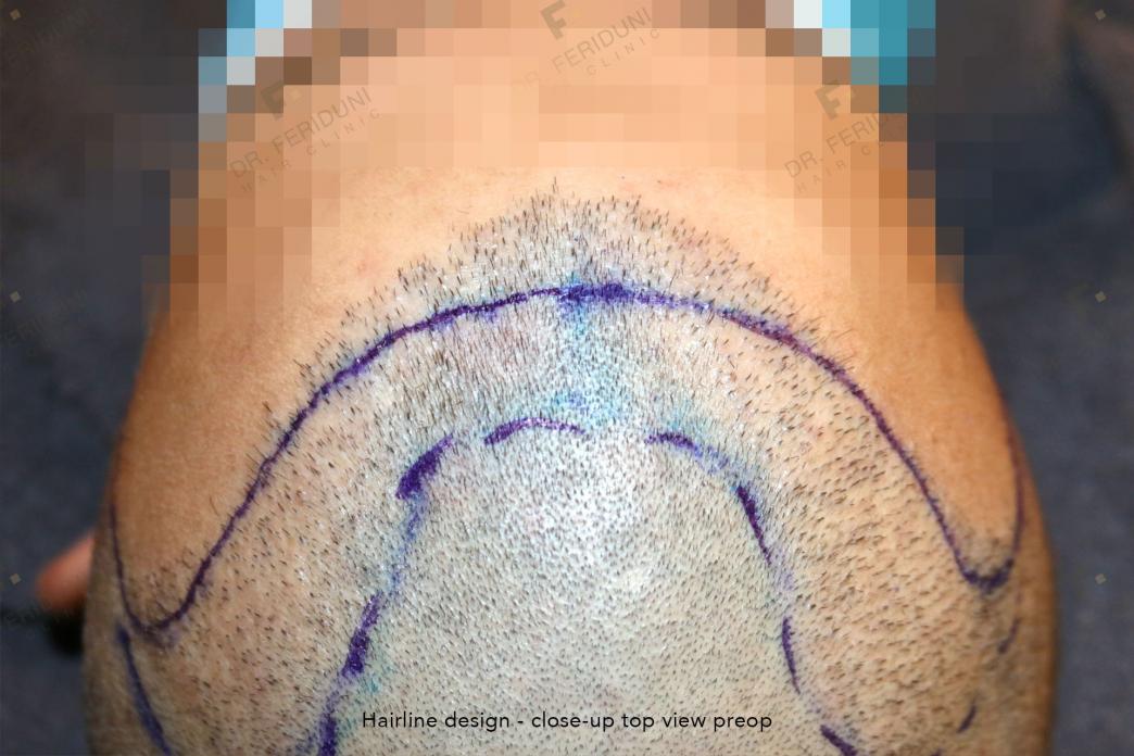 Click image for larger version

Name:	3. Preop Hairline design.jpg

Size:	93.9 KB
ID:	69963