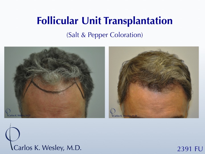 This patient is seen Before/After a 2391 graft 
session with Carlos K. Wesley, M.D. 
 
An interactive Before/After image of this patient can be...