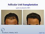 22-year-old male before and after 2507 grafts to the frontal third of his scalp by Dr. Carlos K. Wesley.  
 
A video montage of his transformation...