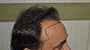 Click image for larger version

Name:	Darling Buds Clinic hair transplant pre op 4.jpg

Size:	92.6 KB
ID:	55398