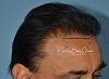 Click image for larger version

Name:	Darling Buds Clinic hair transplant post op 3.jpg

Size:	92.9 KB
ID:	55401