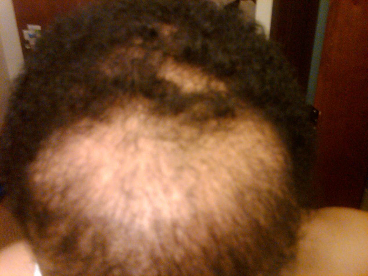 Click image for larger version

Name:	front hairline.jpg

Size:	95.8 KB
ID:	7218