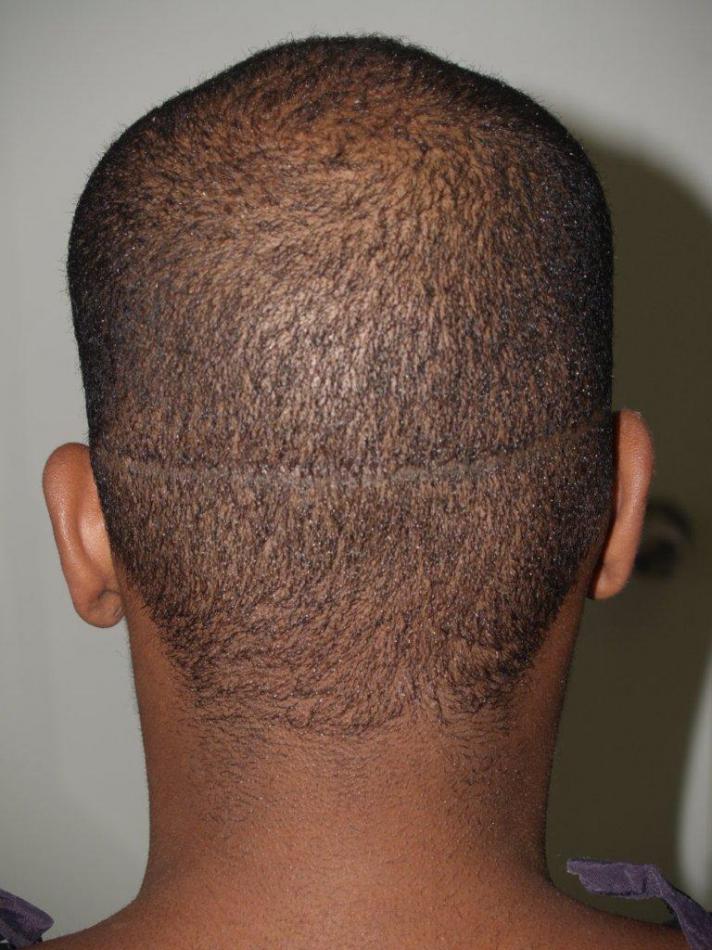 Click image for larger version

Name:	Before FUE Donor Scar.jpg

Size:	94.8 KB
ID:	8945