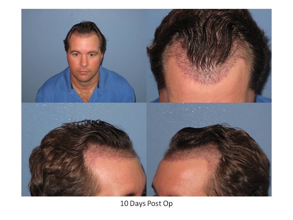 Dr. Paul Shapiro, MD  
FUT 
2164 grafts/ 4395 hairs 
12 months post-op