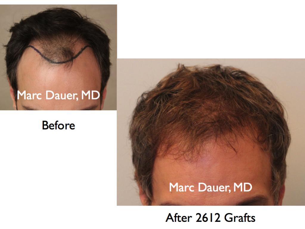 Click image for larger version

Name:	Hair Transplant Slides5.037.jpg

Size:	62.5 KB
ID:	23657