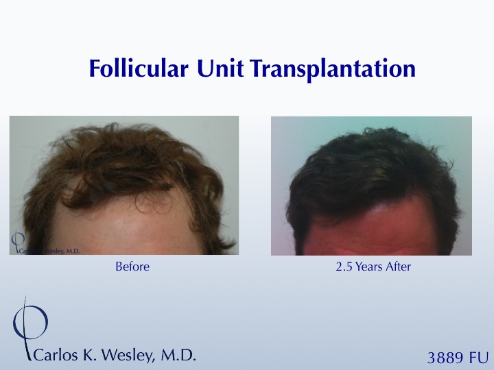 This patient had a session with Dr. Carlos K. Wesley (NYC) to increase the hair density throughout the frontal half of his scalp and improve the...