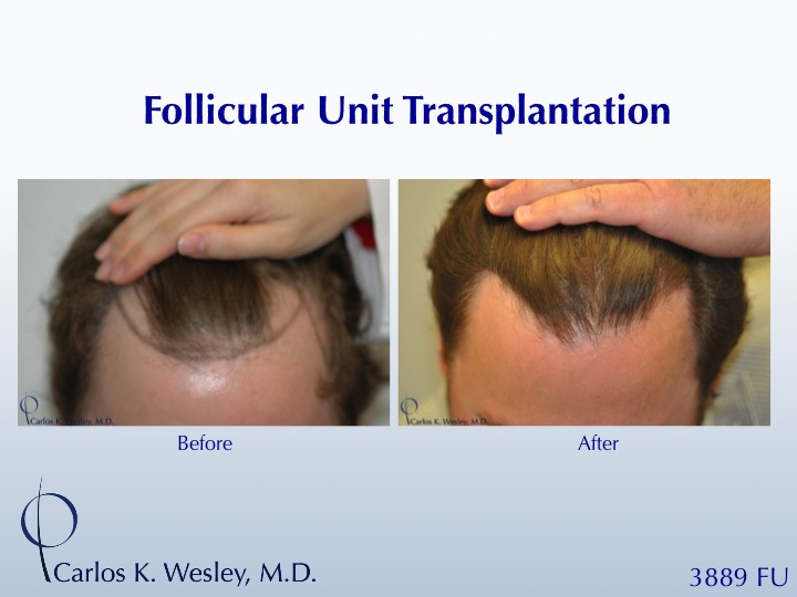 This patient had a session with Dr. Carlos K. Wesley (NYC) to increase the hair density throughout the frontal half of his scalp and improve the...