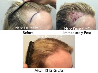 Click image for larger version

Name:	Hair Transplant Slides copy15.004.jpg

Size:	17.1 KB
ID:	43995