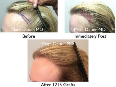 Click image for larger version

Name:	Hair Transplant Slides copy15.005.jpg

Size:	17.0 KB
ID:	43996