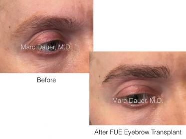 fue eyebrow transplant patient of Dr. Marc Dauer