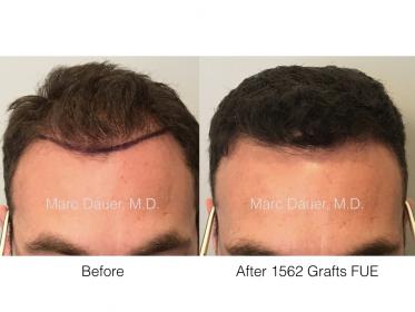 1562 grafts FUE performed by Dr. Marc Dauer