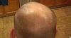 Click image for larger version

Name:	baldness-01.jpg

Size:	95.8 KB
ID:	43149