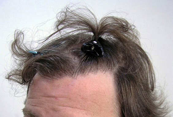 HAIRLINE CLOSEUP