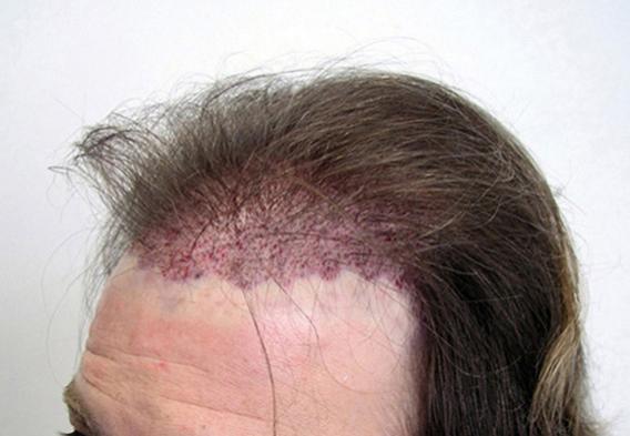 IMMEDIATELY AFTER 1630 FOLLICULAR UNITS PLACED