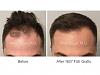 1627 FUE Grafts performed by Dr. Marc Dauer