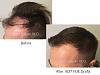 1627 FUE Grafts performed by Dr. Marc Dauer