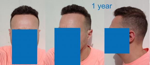 Click image for larger version

Name:	hairline after 1 year front and side.jpg

Size:	16.6 KB
ID:	68153