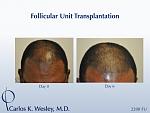 Patients are not required to shave their heads for a traditional strip harvest approach to hair restoration surgery. Instead, they are encouraged to...