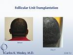 Patients are not required to shave their heads for a traditional strip harvest approach to hair restoration surgery. Instead, they are encouraged to...
