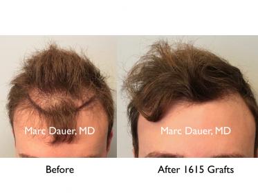 Click image for larger version

Name:	Hair Transplant Slides copy07.001.jpg

Size:	14.3 KB
ID:	50473
