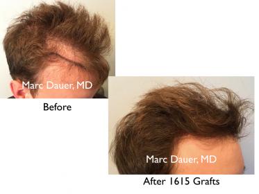 Click image for larger version

Name:	Hair Transplant Slides copy07.002.jpg

Size:	13.4 KB
ID:	50474