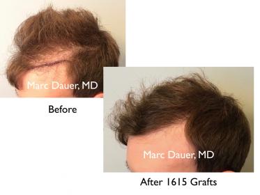 Click image for larger version

Name:	Hair Transplant Slides copy07.003.jpg

Size:	12.7 KB
ID:	50475
