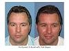 Dr. Paul Shapiro, MD  
FUT 
2164 grafts/ 4395 hairs 
12 months post-op
