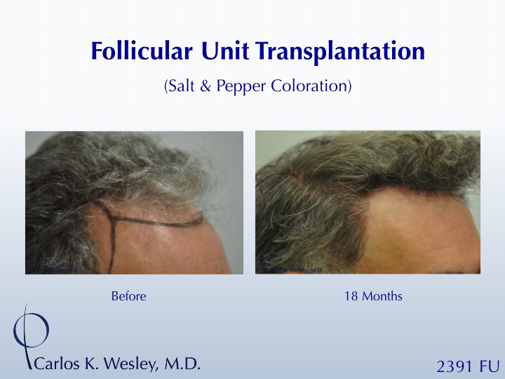 46-year-old male with curly hair of salt & pepper coloration underwent two sessions totaling 4637 FU with Dr. Carlos K. Wesley (NYC).