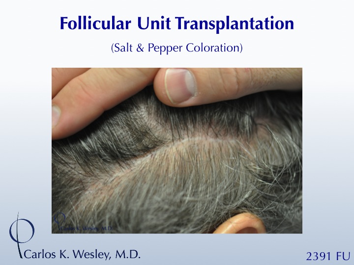 46-year-old male with curly hair of salt & pepper coloration underwent two sessions totaling 4637 FU with Dr. Carlos K. Wesley (NYC).  His resultant...