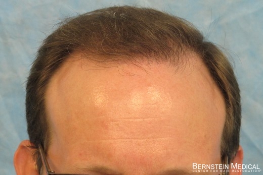 Click image for larger version

Name:	04_after-hair-transplant.jpg

Size:	96.1 KB
ID:	44109