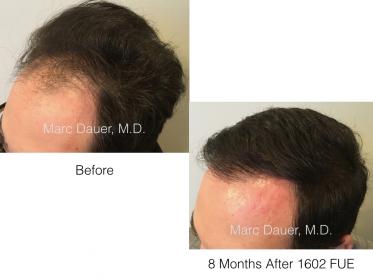 1601fue.FUE results of Dr. Marc Dauer