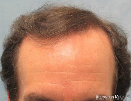 After 1st Session  - Detail of Hairline 
 
View his full photoset >>...