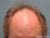 Bernstein Medical's Patient FVR Before Hair Transplant - Detail of Hairline 
 
View his full photoset >>...