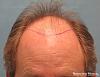 Bernstein Medical's Patient FVR Position of Planned Hairline - Detail of Hairline 
 
View his full photoset >>...