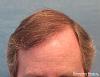 Bernstein Medical's Patient FVR, hair transplant results after one session - Detail of Hairline 
 
View his full photoset >>...