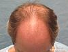 Bernstein Medical's Patient FVR, before hair transplant - Top View 
 
View his full photoset >>...