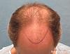 Bernstein Medical's Patient FVR, proposed hairline - Top View 
 
View his full photoset >>...