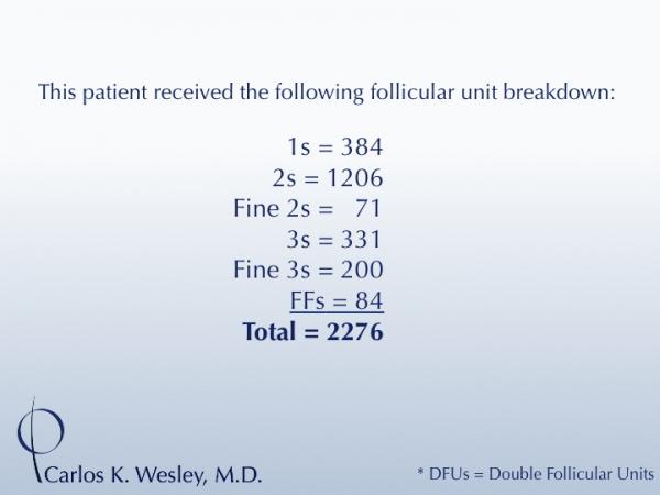 Follicular Unit (FU) breakdown of a 2276-graft session of FUT with Dr. Carlos K. Wesley. 
 
View his transformation at: https://vimeo.com/67247877