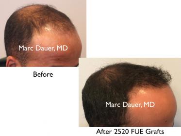 Click image for larger version

Name:	Hair Transplant Slides copy60.003.jpg

Size:	12.0 KB
ID:	46989