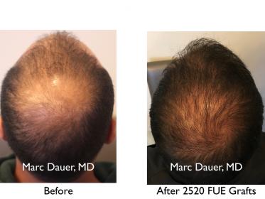 Click image for larger version

Name:	Hair Transplant Slides copy60.005.jpg

Size:	14.7 KB
ID:	46992