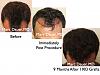 Click image for larger version

Name:	Hair Transplant Slides5.323.jpg

Size:	70.8 KB
ID:	35802