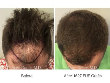 1627 FUE Grafts performed by Dr. Marc Dauer