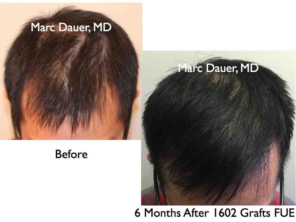 Click image for larger version

Name:	Hair Transplant Slides.524.jpg

Size:	41.3 KB
ID:	38423