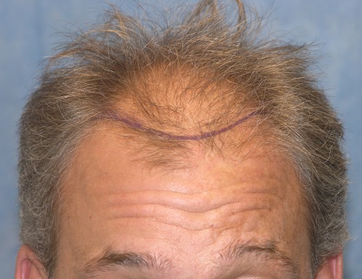 Click image for larger version

Name:	04_position-of-hairline.jpg

Size:	64.6 KB
ID:	7531